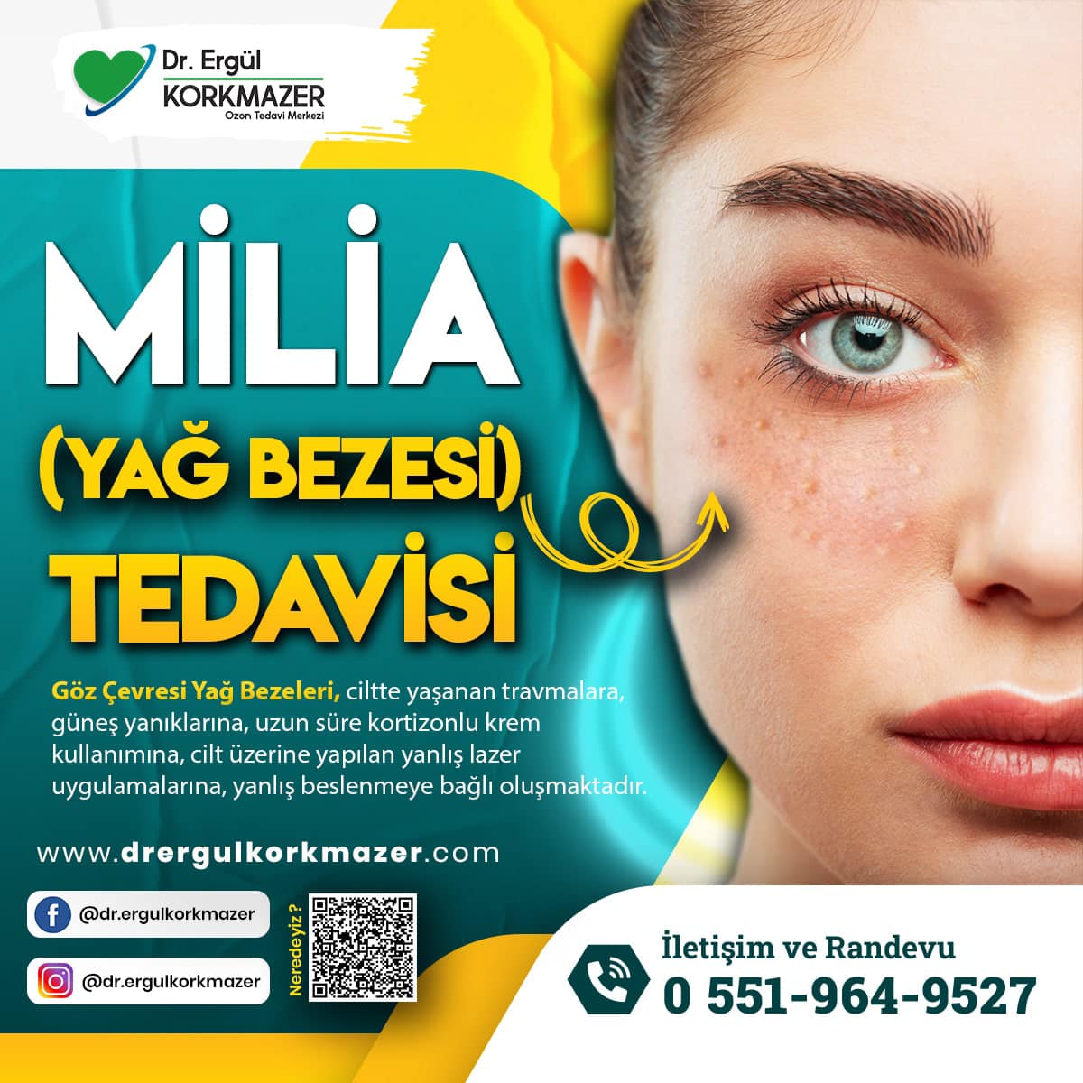 MİLİA YAĞ BEZESİ TEDAVİSİ