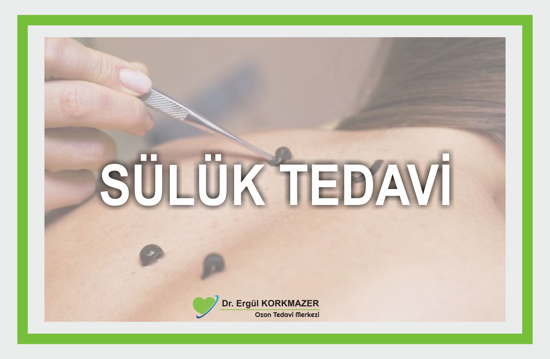 SÜLÜK TEDAVİSİ